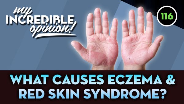 Ep 116- What Causes Eczema & Red Skin Syndrome?